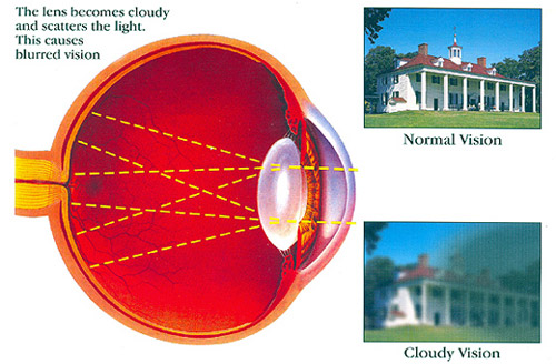 Cataract