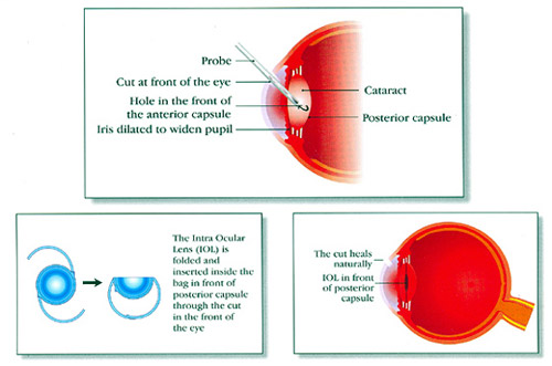 cataract surgery