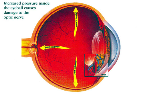 Lasik