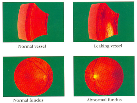 Know about Vitreo-Retina