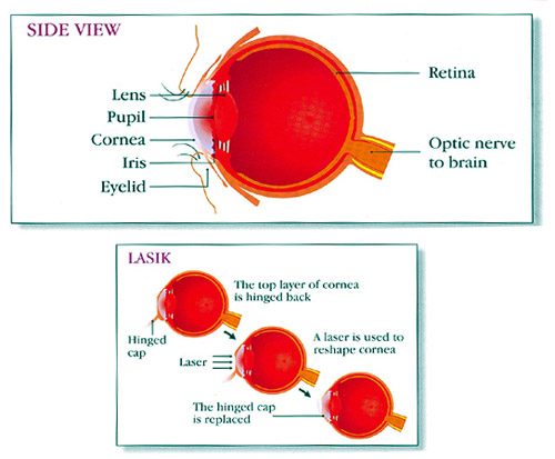 Lasik